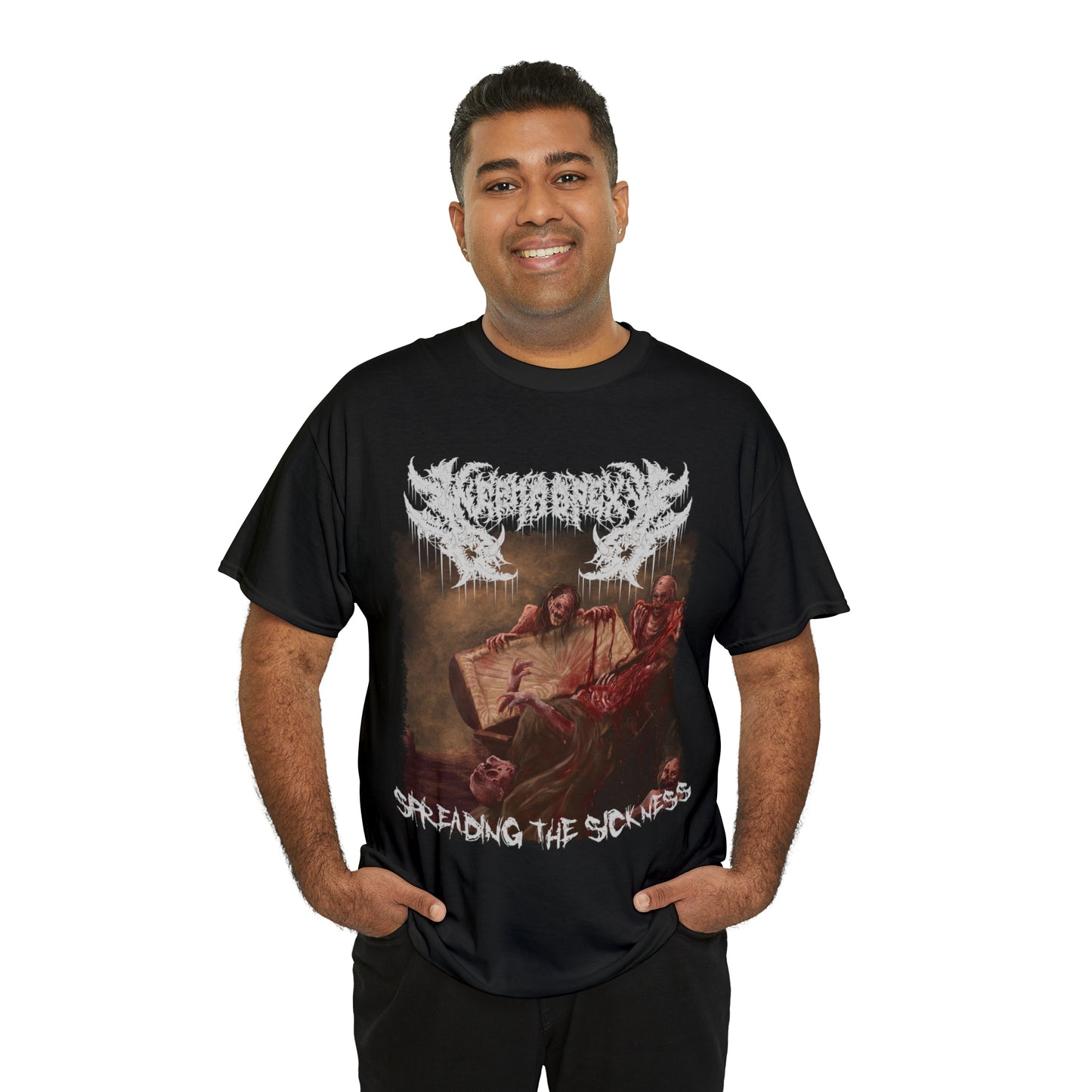 Nephropexy - Spreading the Sickness
