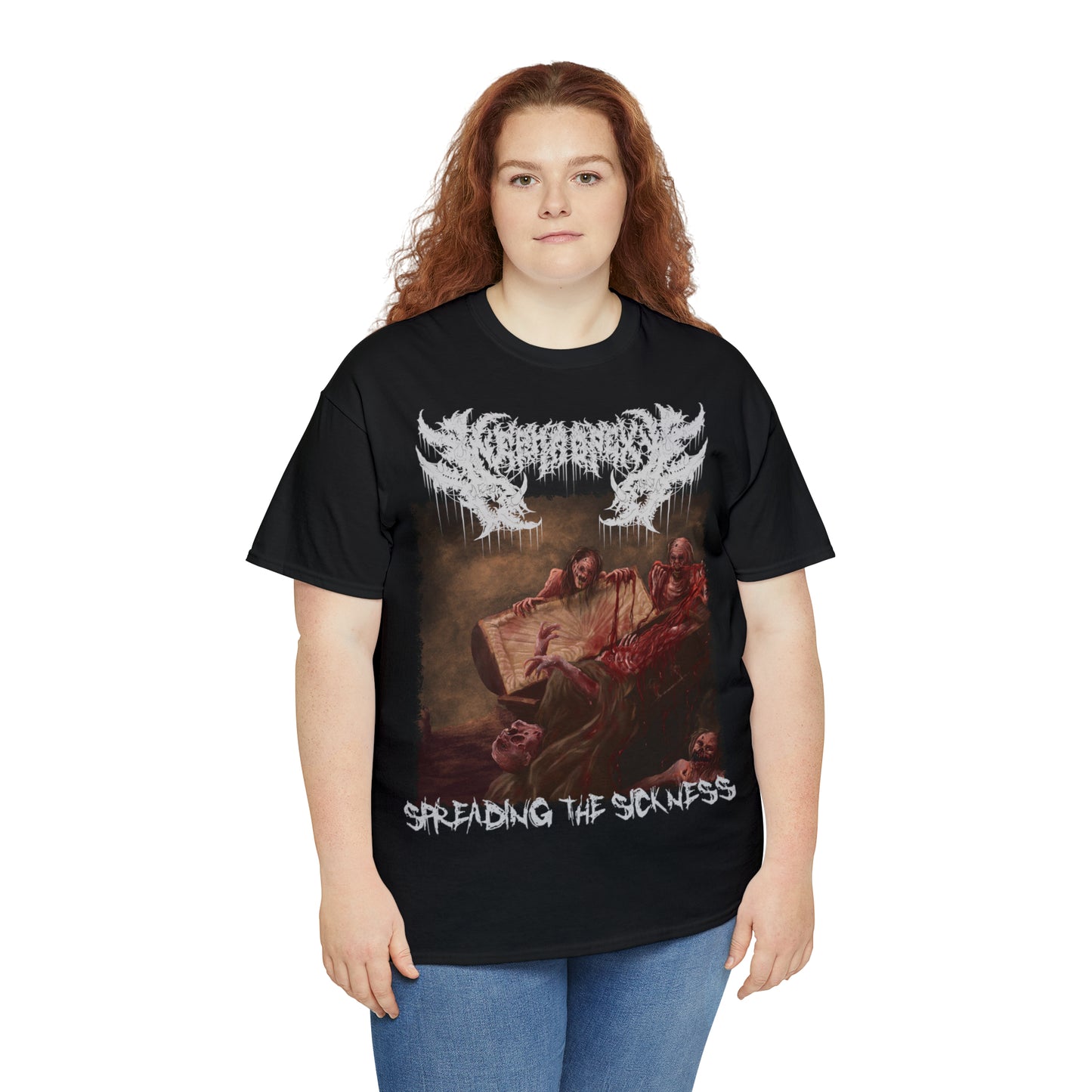 Nephropexy - Spreading the Sickness