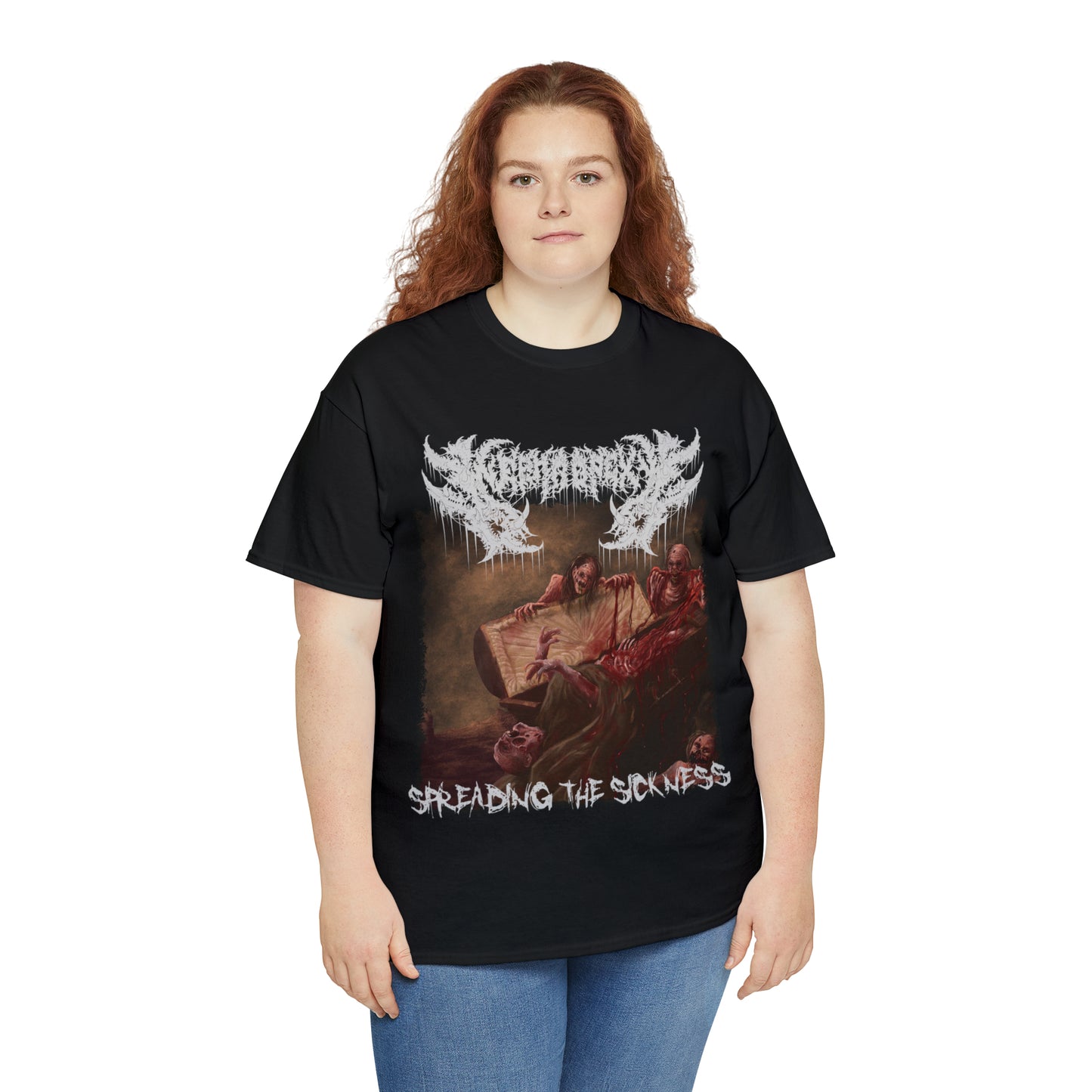 Nephropexy - Spreading the Sickness