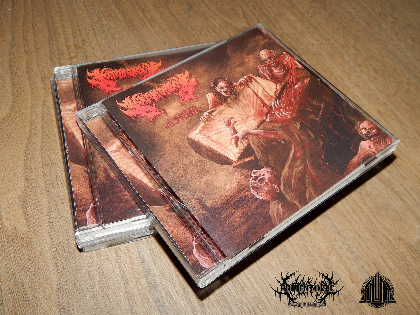Nephropexy - Spreading the Sickness
