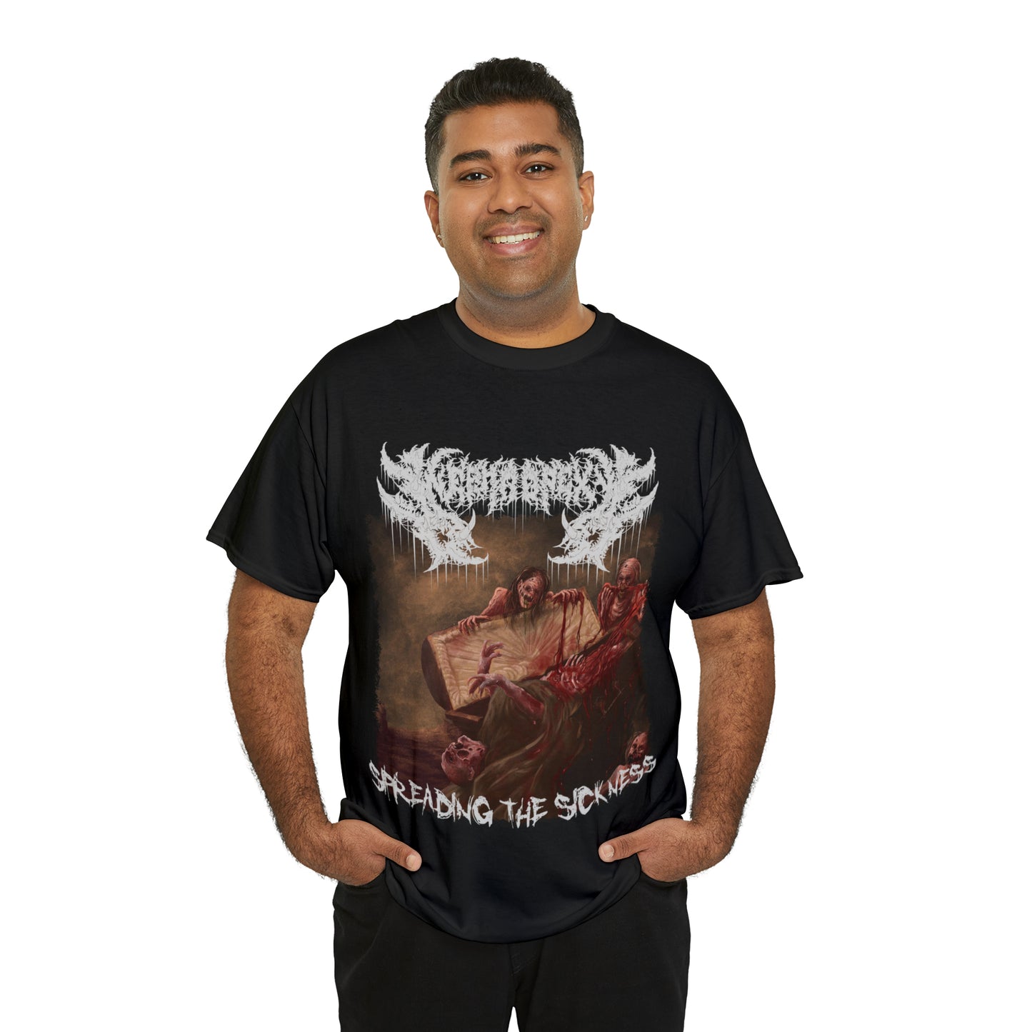 Nephropexy - Spreading the Sickness